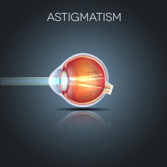 Анатомия на окото с астигматизъм